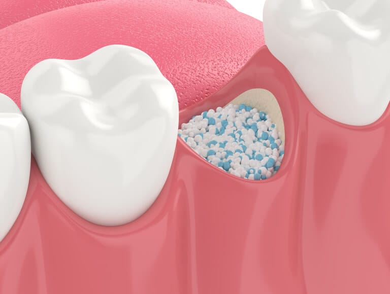 Is bone grafting right for you — Dentists of SLO San Luis Obispo