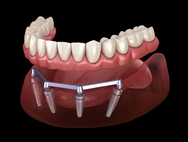 Obispo Patients Choose All-On-4®