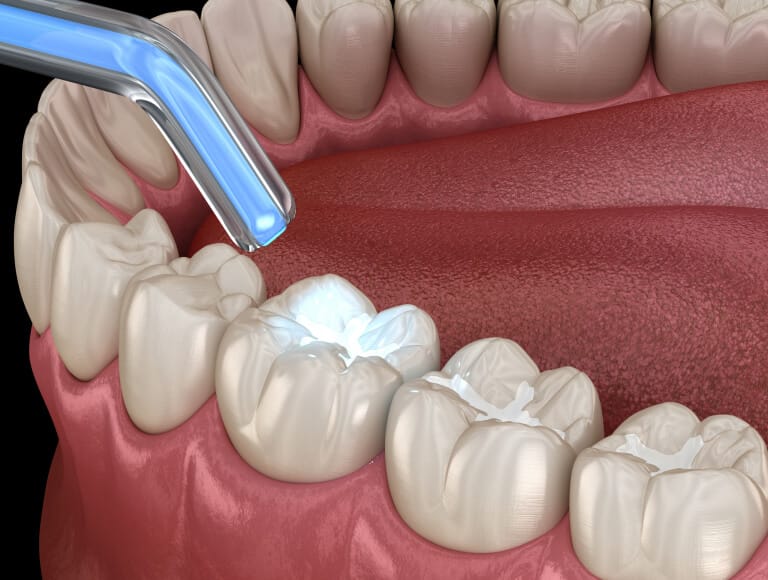 When do you need a dental filling — Dentists of SLO San Luis Obispo