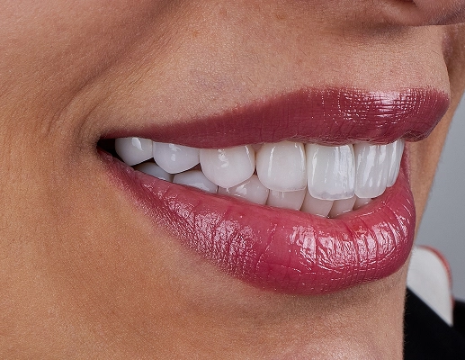 Dental Veneers in San Luis Obispo, CA