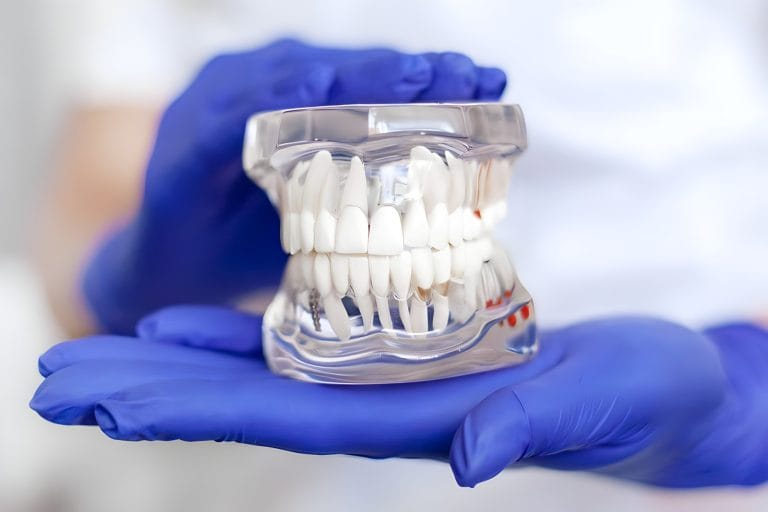 Benefits of Teeth-In-A-Day